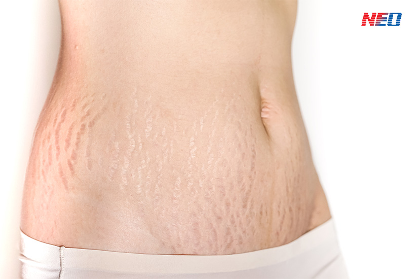 รอยแตกลายขาว | Striae Alba)